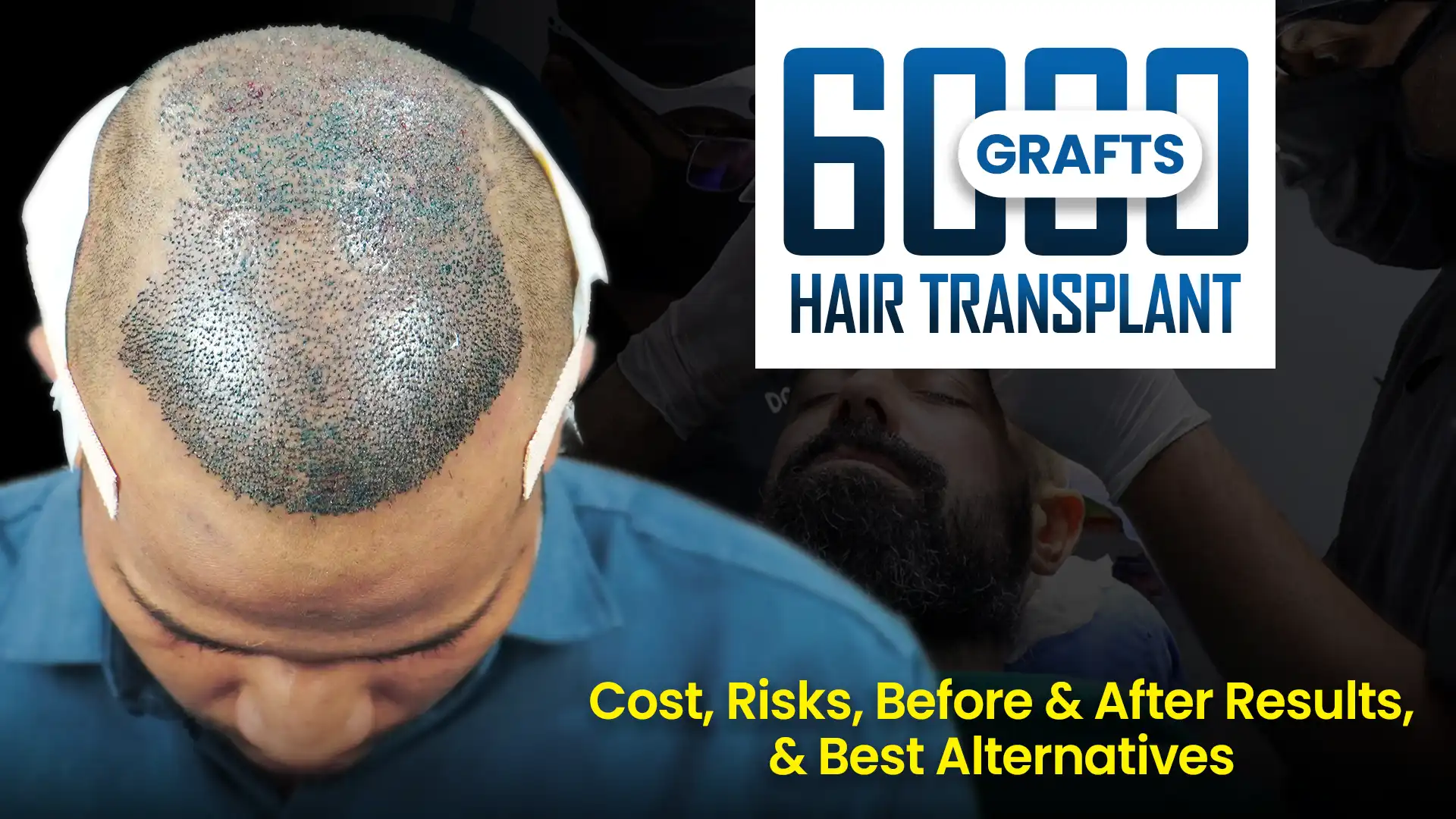 6000 Graft Hair Transplant results and procedure