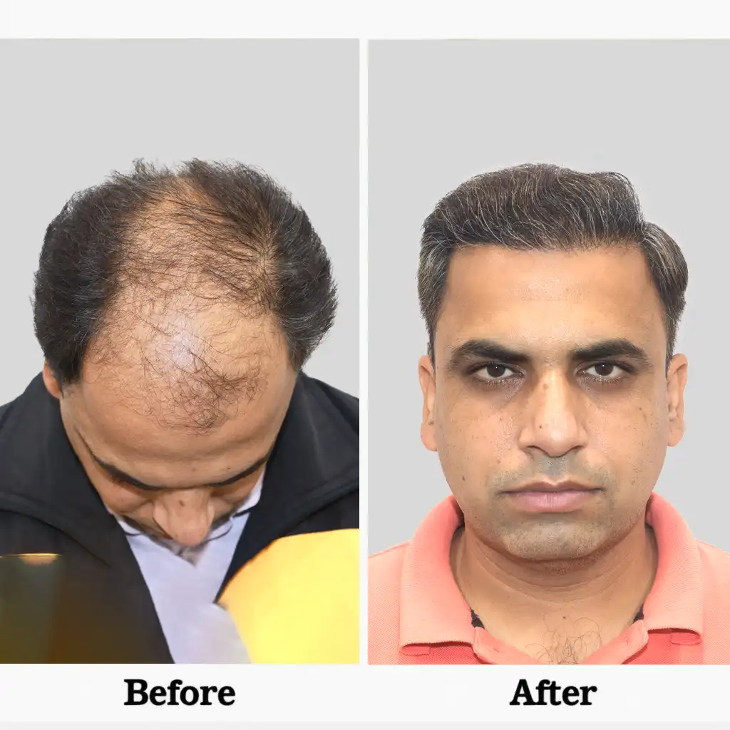 Big FUE hair transplant cost in Kochi detail