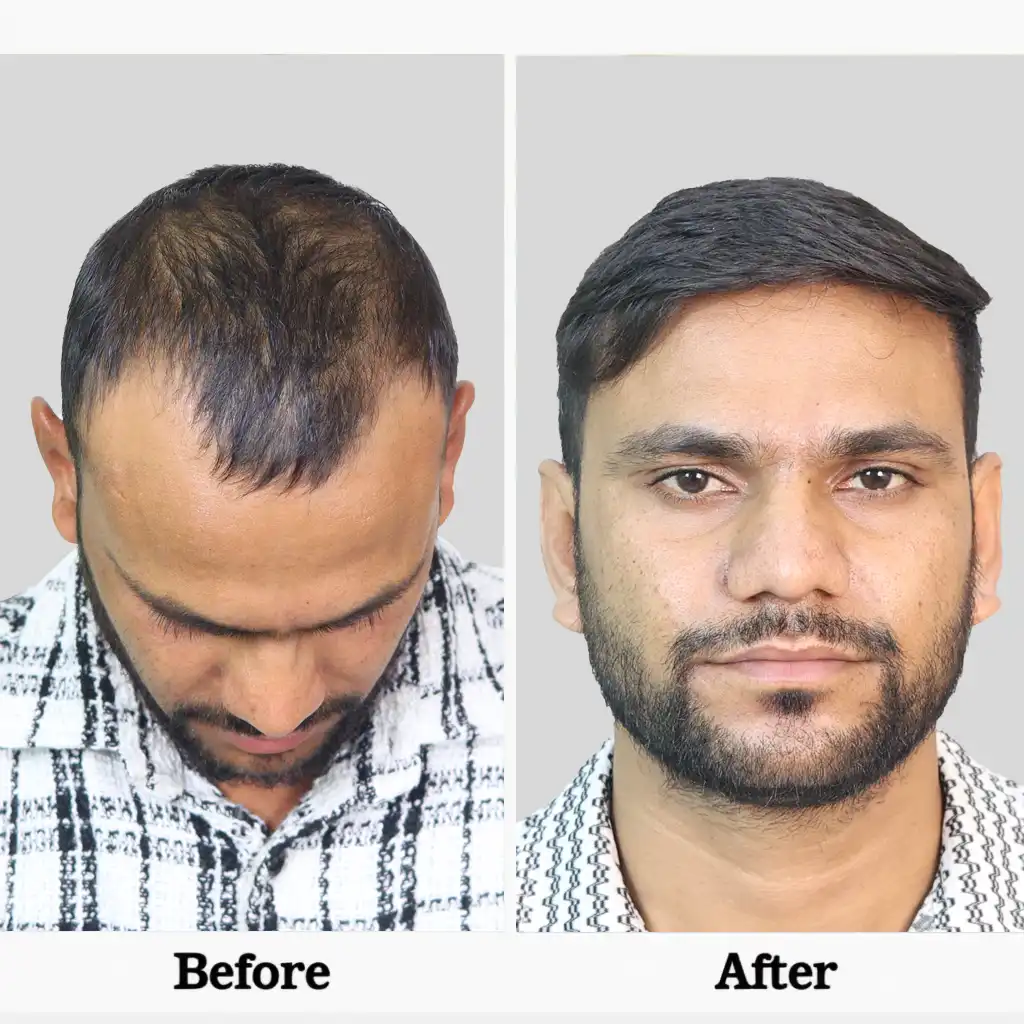 Hair Transplant Cost in Chandigarh 11 I FUE hair transplant cost in Chandigarh details