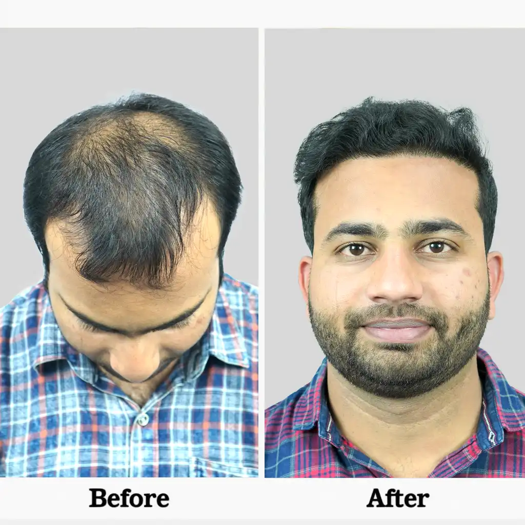 Before After .1I FUE 1 4