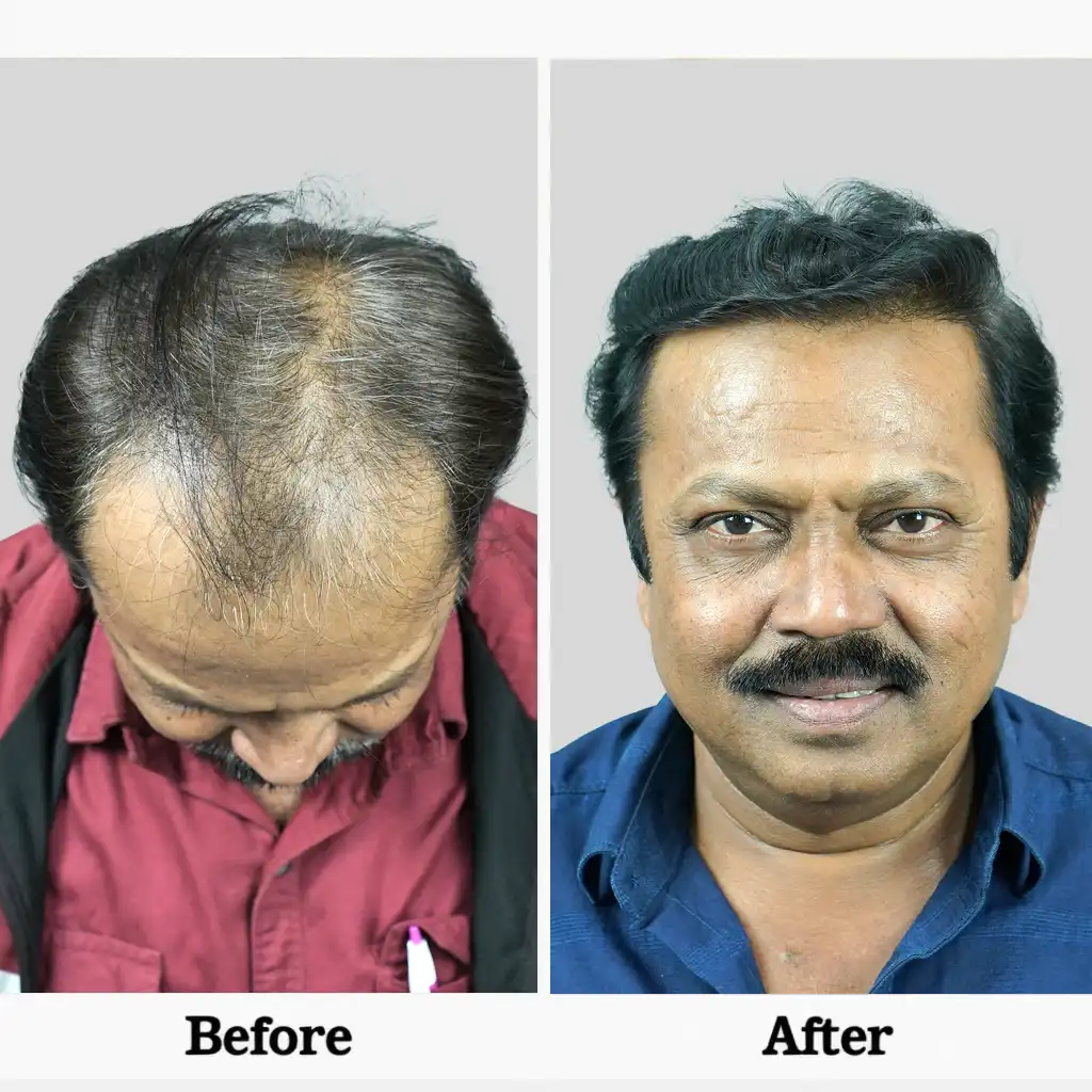 Big FUE hair transplant cost in rajkot detail