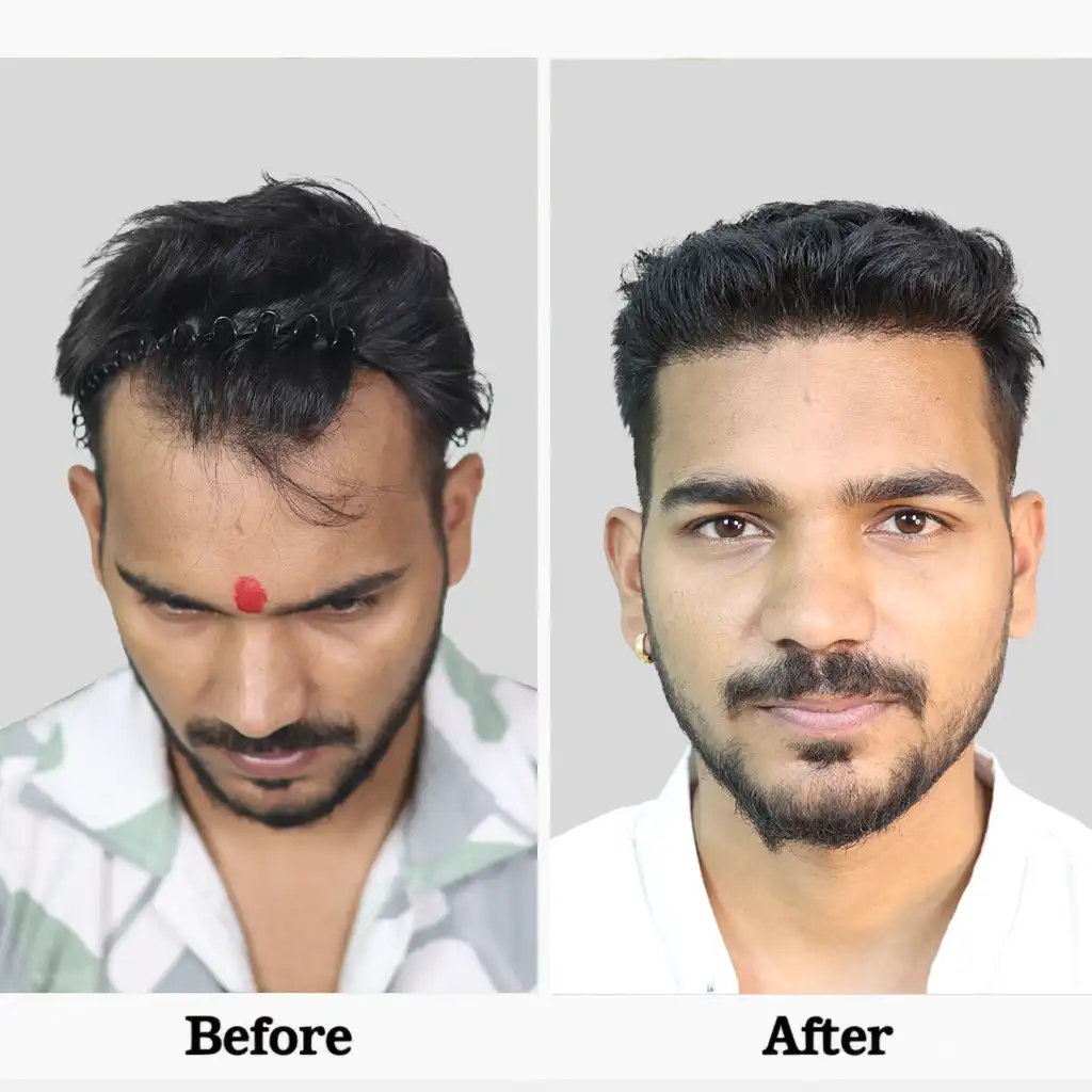 Hair Transplant Cost in Chandigarh 10 Big FUE hair transplant cost in Chandigarh detail