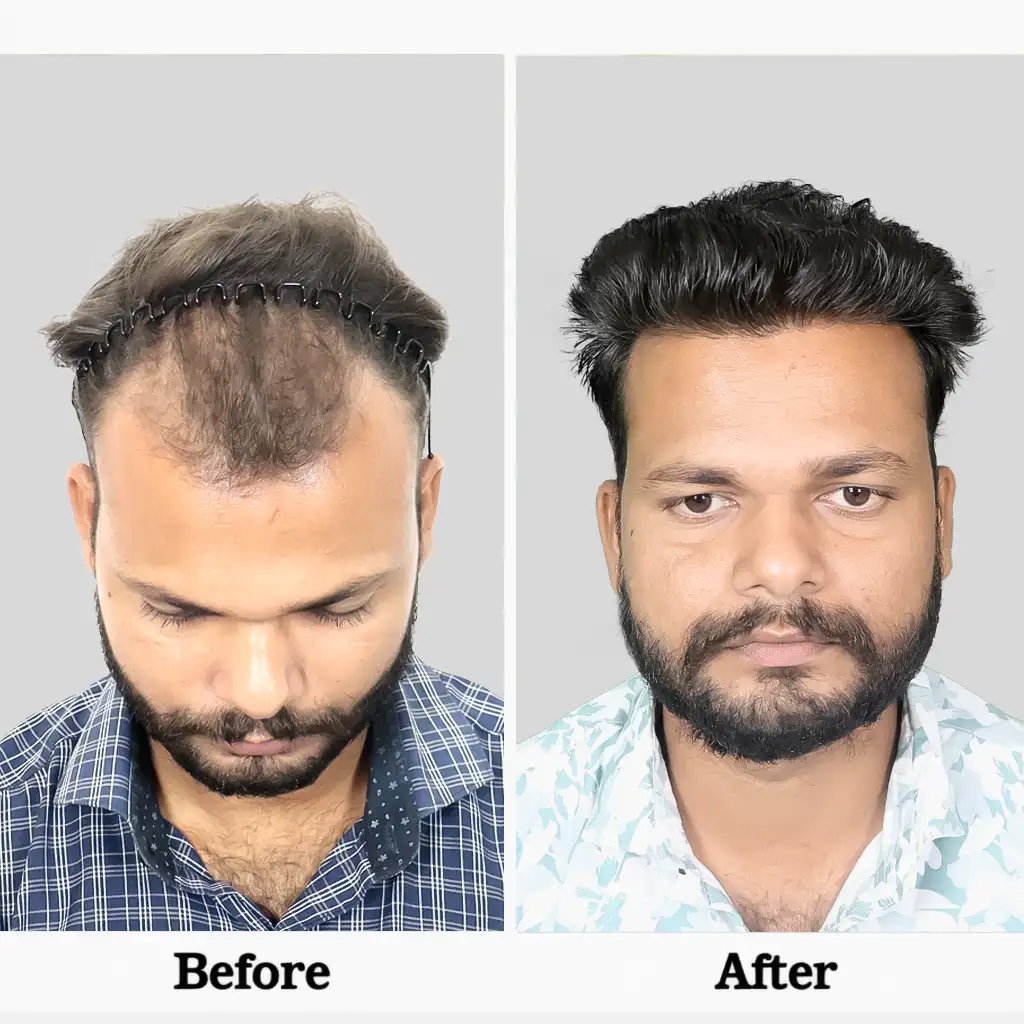 Before After .2I FUE