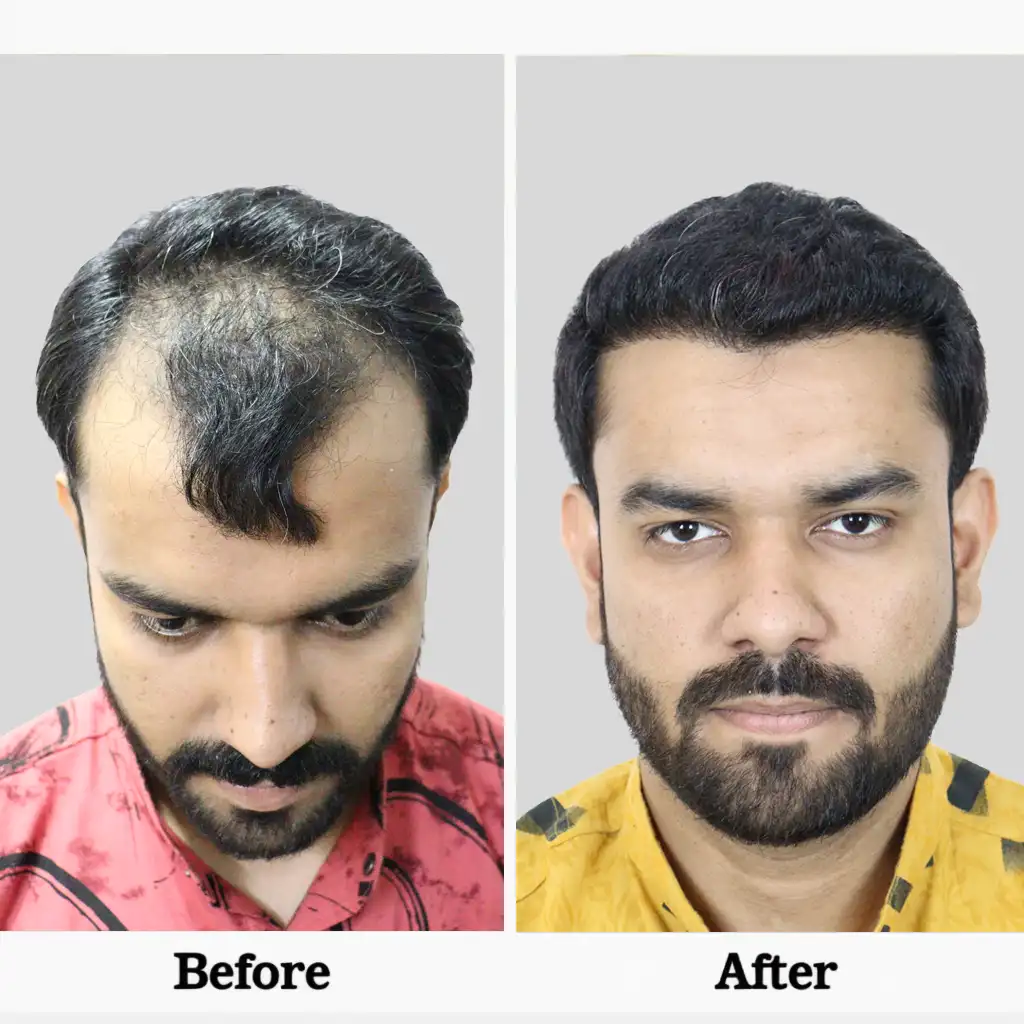Bio FUE hair transplant cost in Ludhiana detail