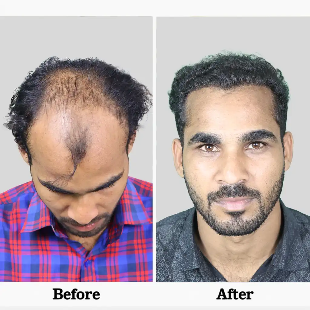 Hair Transplant Cost in Chandigarh 12 Before After .3BIO FUE 1 2