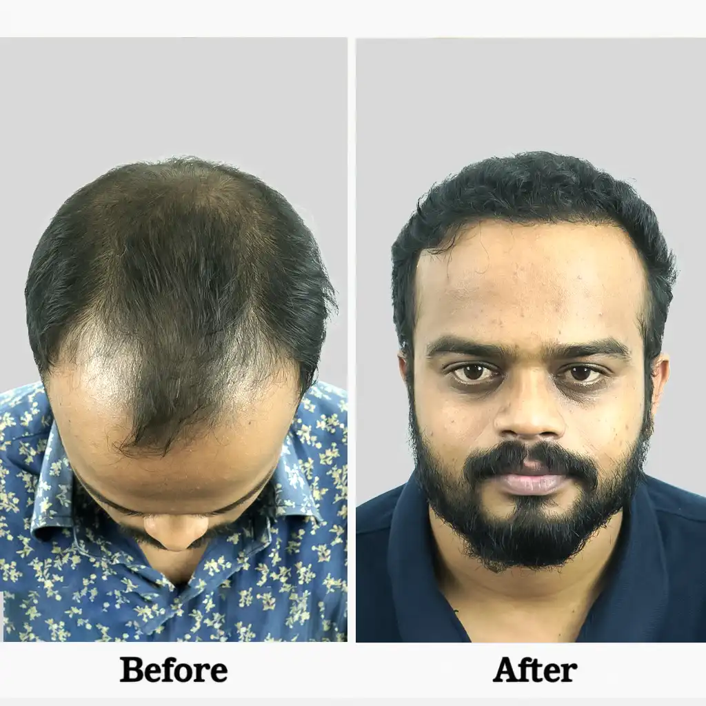 Before After .3BIO FUE 1 3