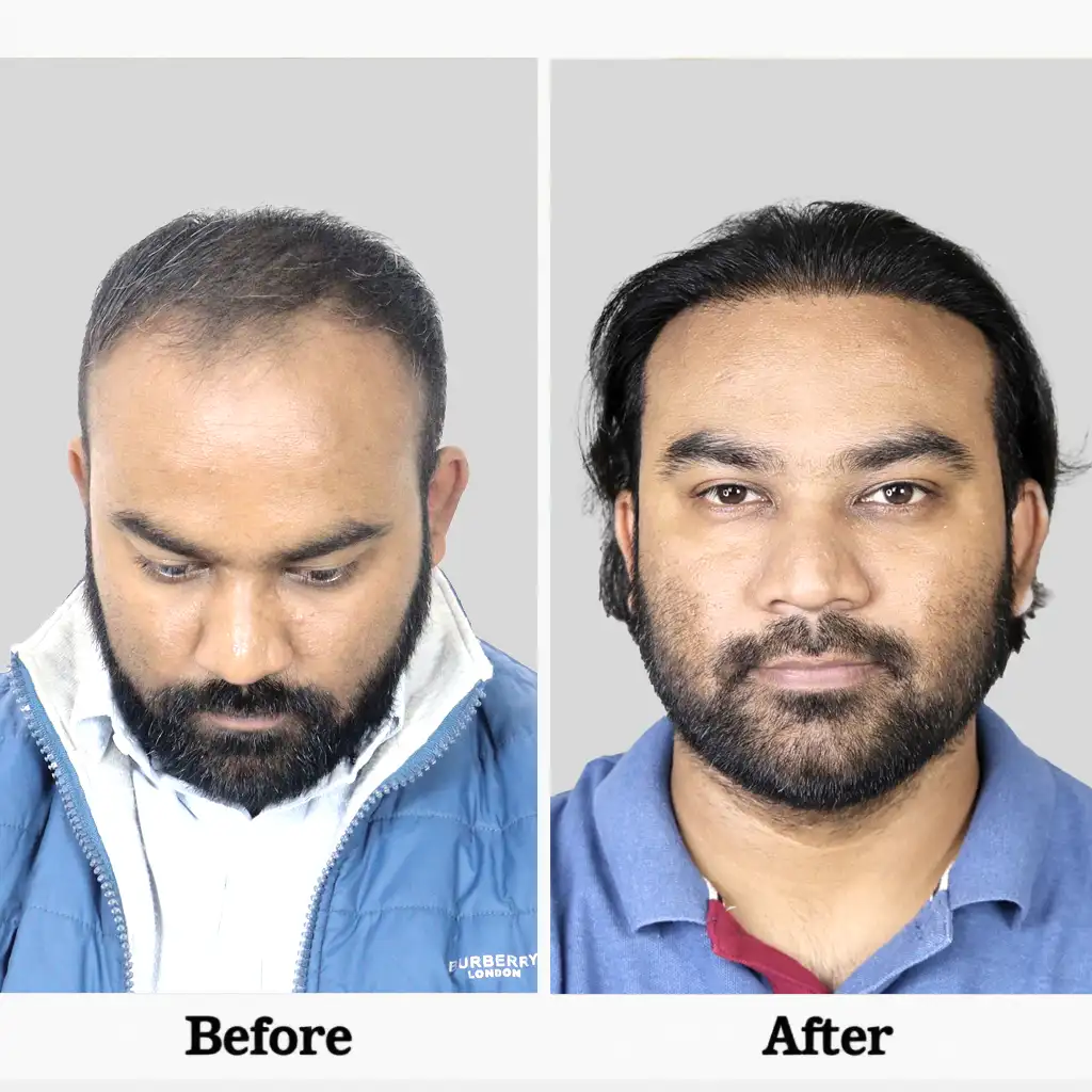 Bio FUE hair transplant cost in Kochi detail