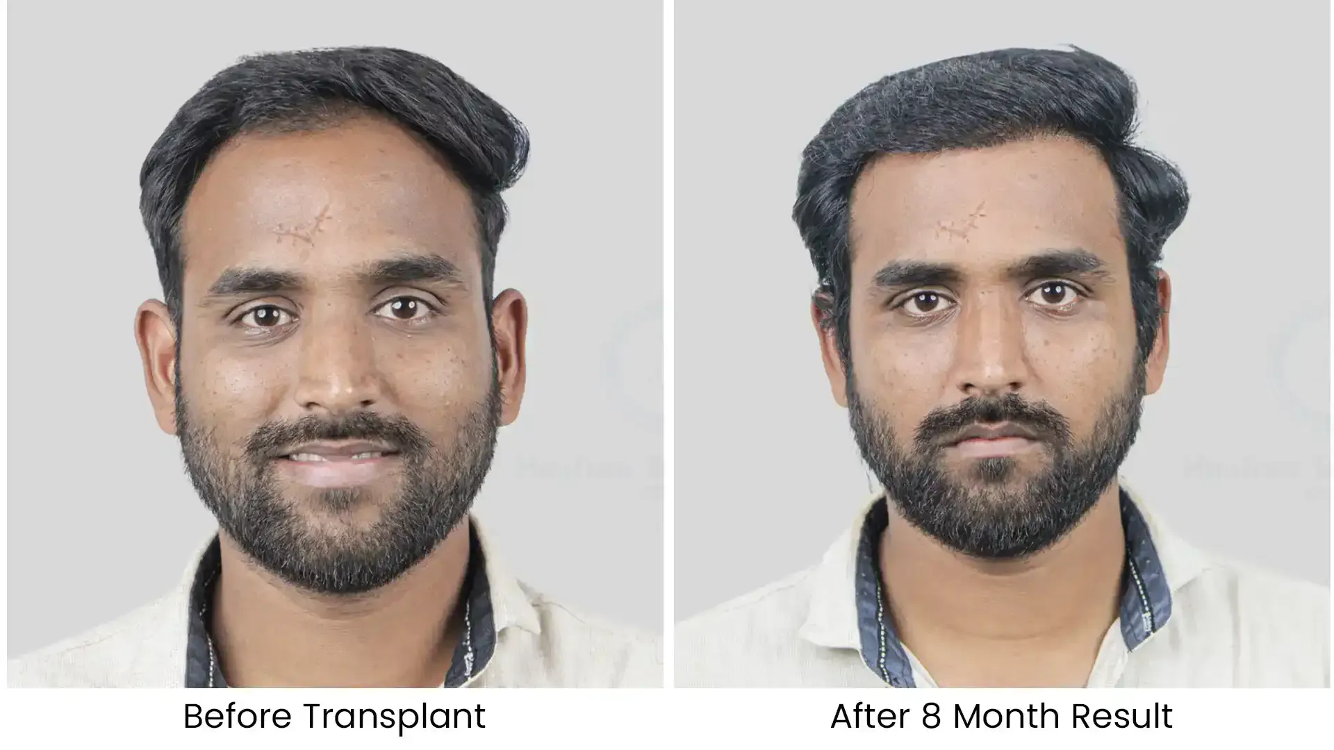 Before - after hair transplant - 1