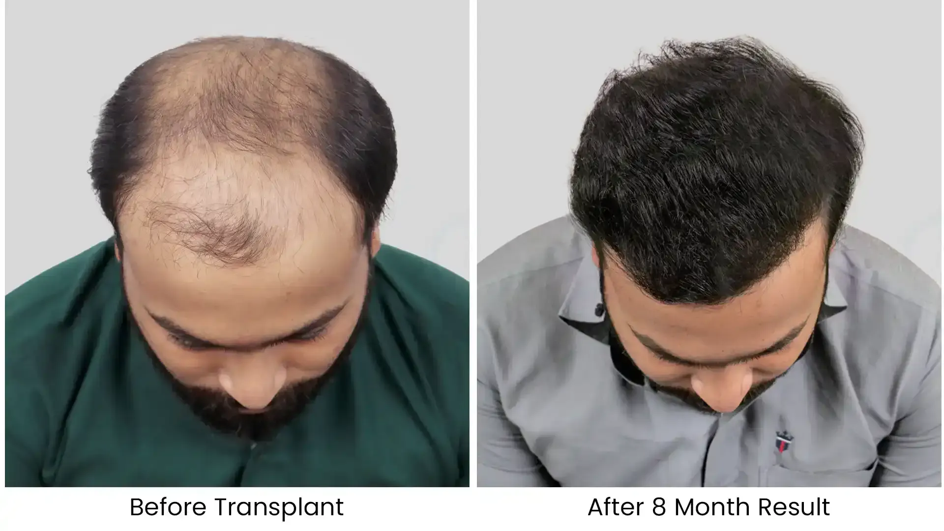 Before - after hair transplant - 1