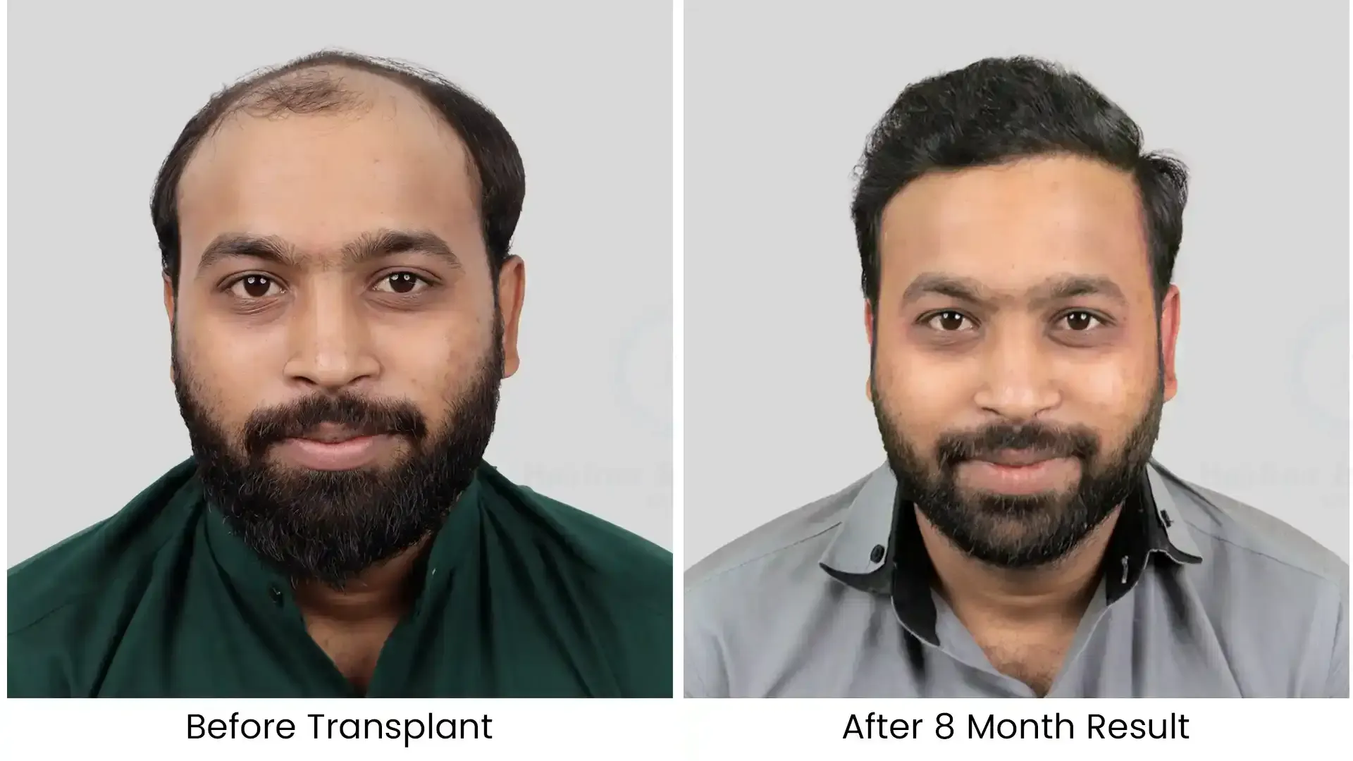 Before - after hair transplant - 1
