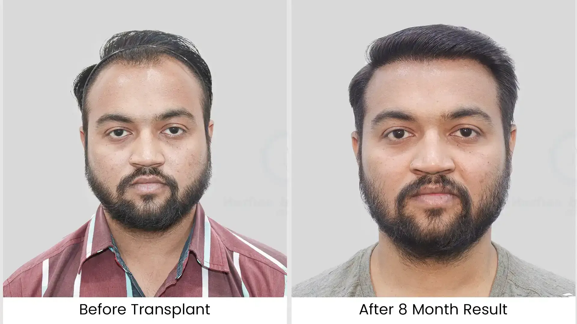 Before - after hair transplant - 1