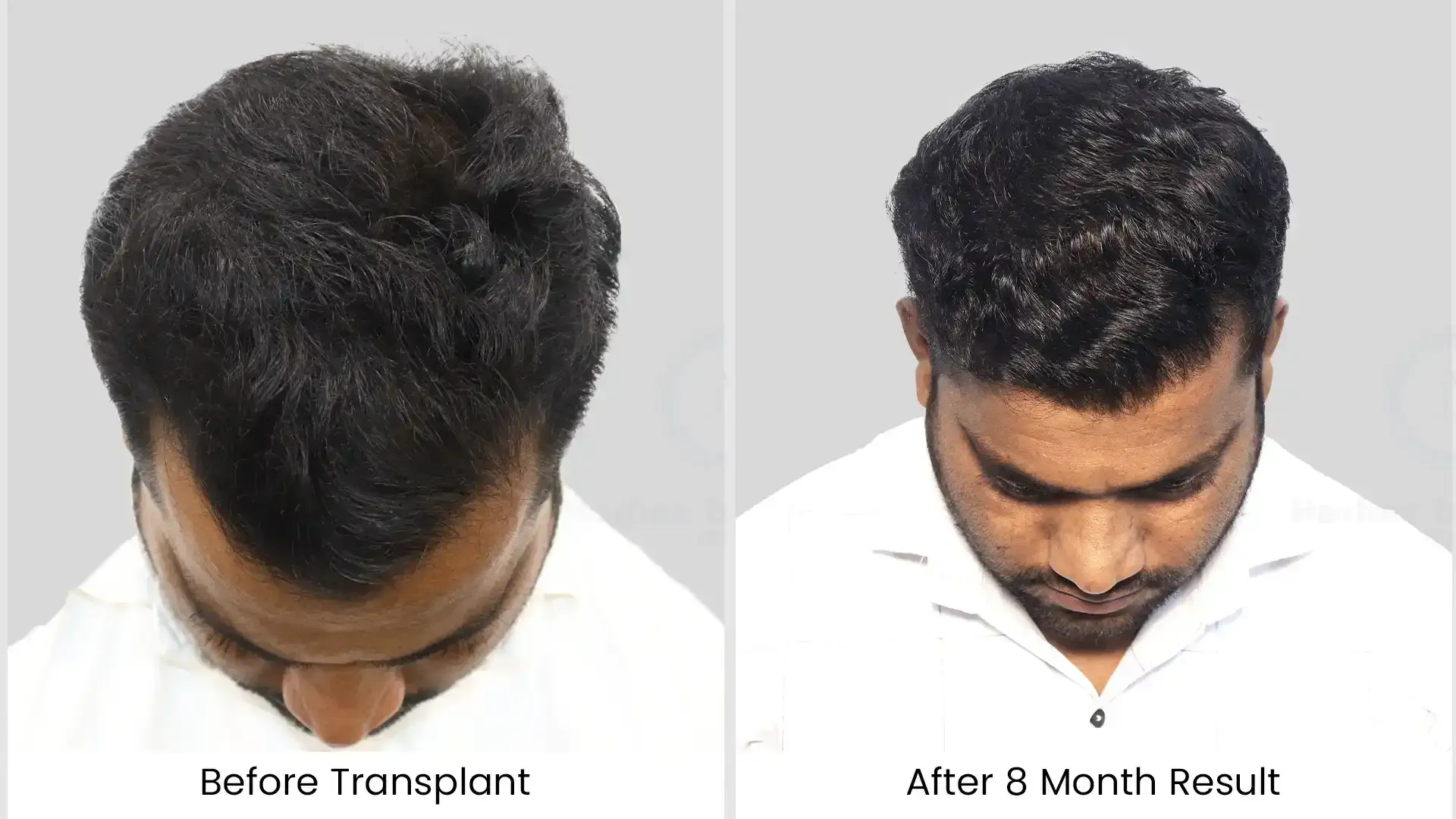 Hair Transplant Cost in Chandigarh 17 Before - after hair transplant - 2
