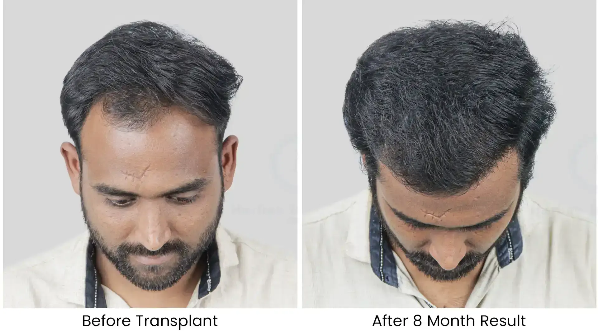 Before - after hair transplant - 2