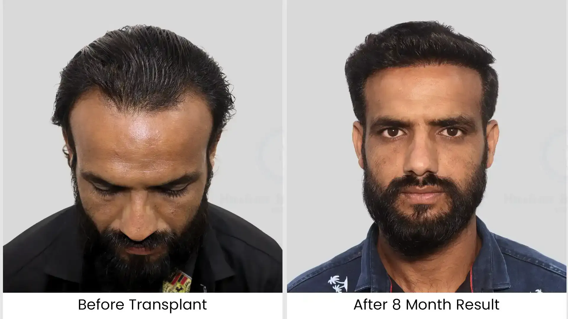 Hair Transplant Cost in Chandigarh 16 Before - after hair transplant - 3