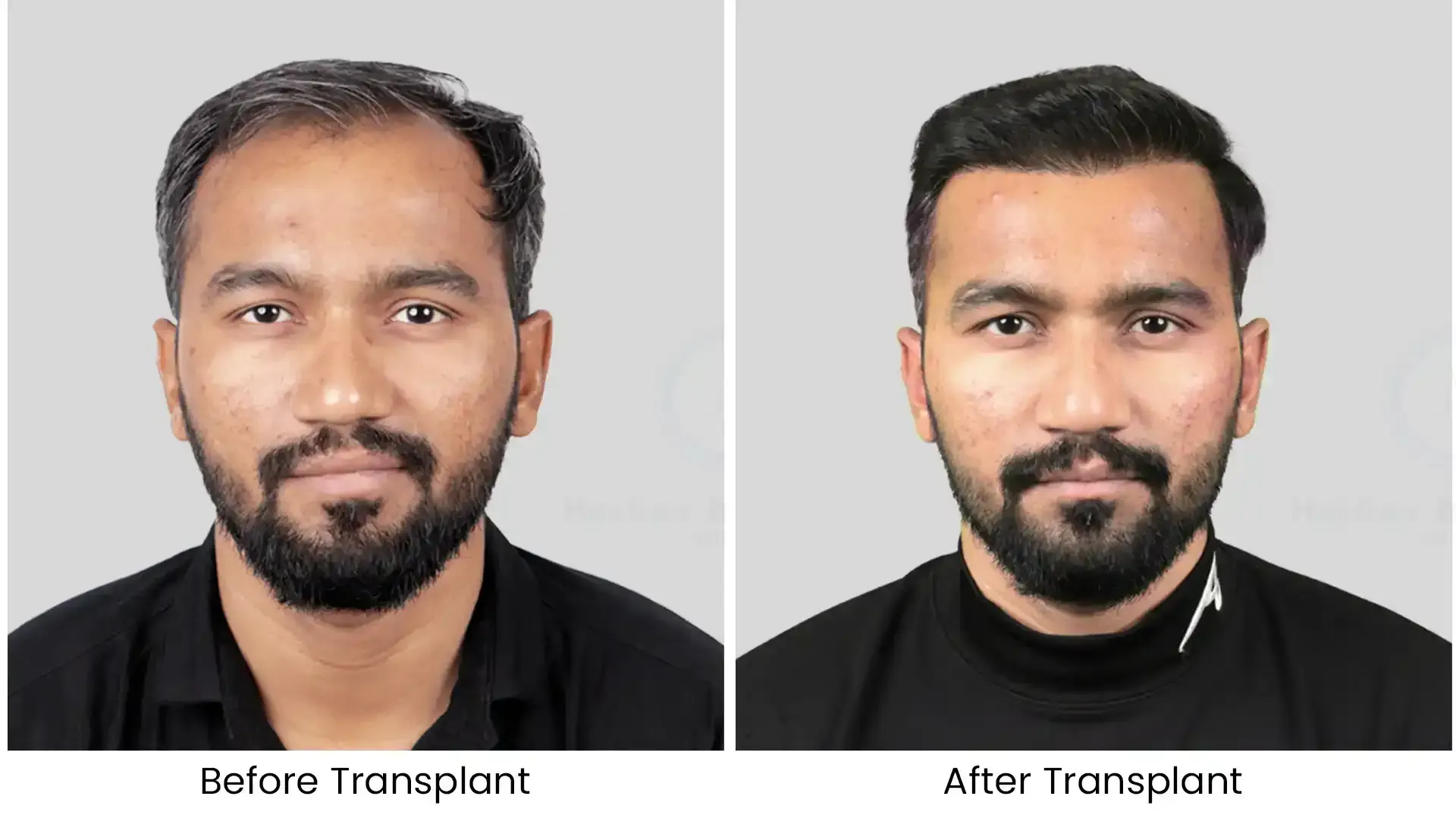 Before - after hair transplant - 3