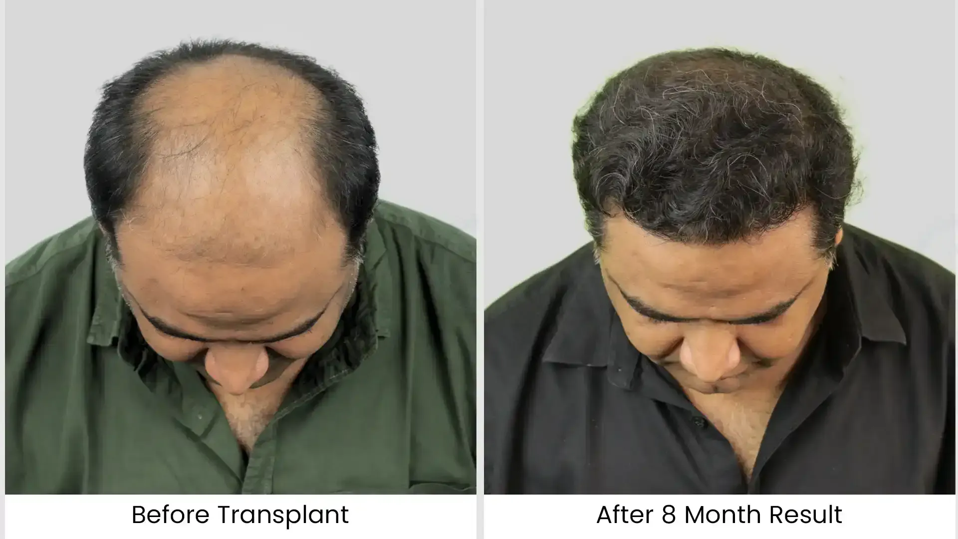 Before - after hair transplant - 3