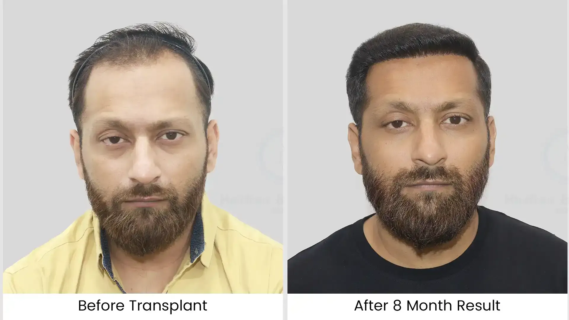 Before - after hair transplant - 3