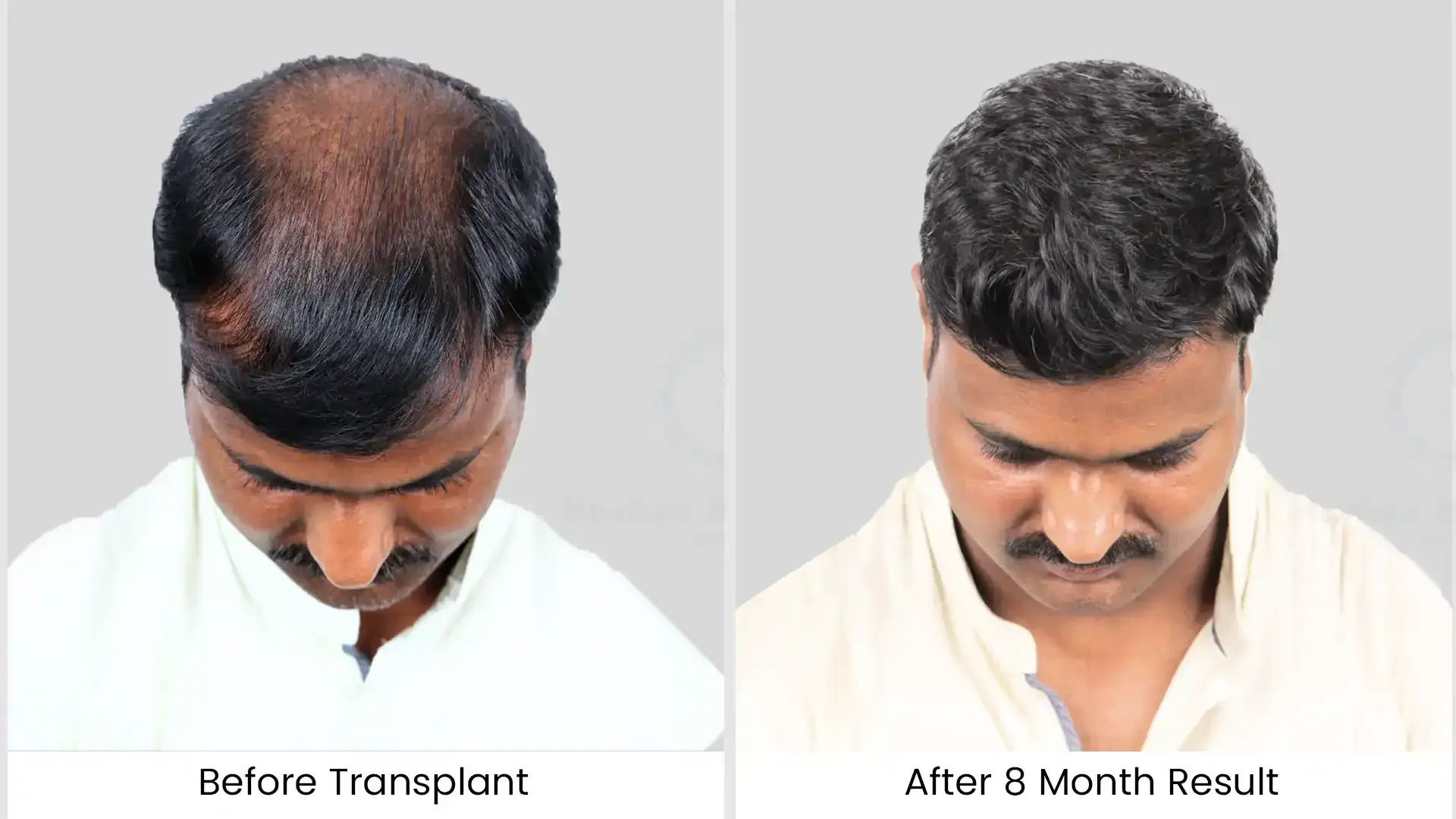 Before - after hair transplant - 3