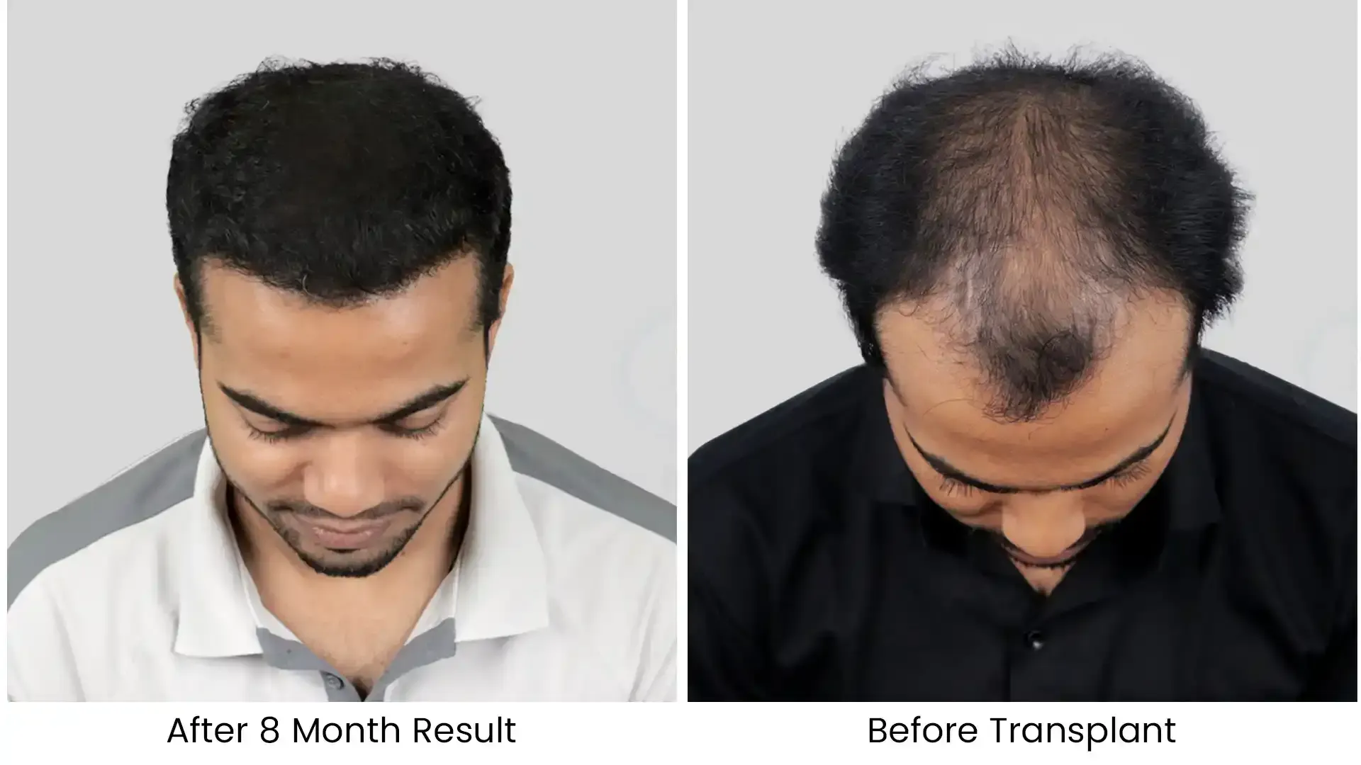 Before - after hair transplant - 3