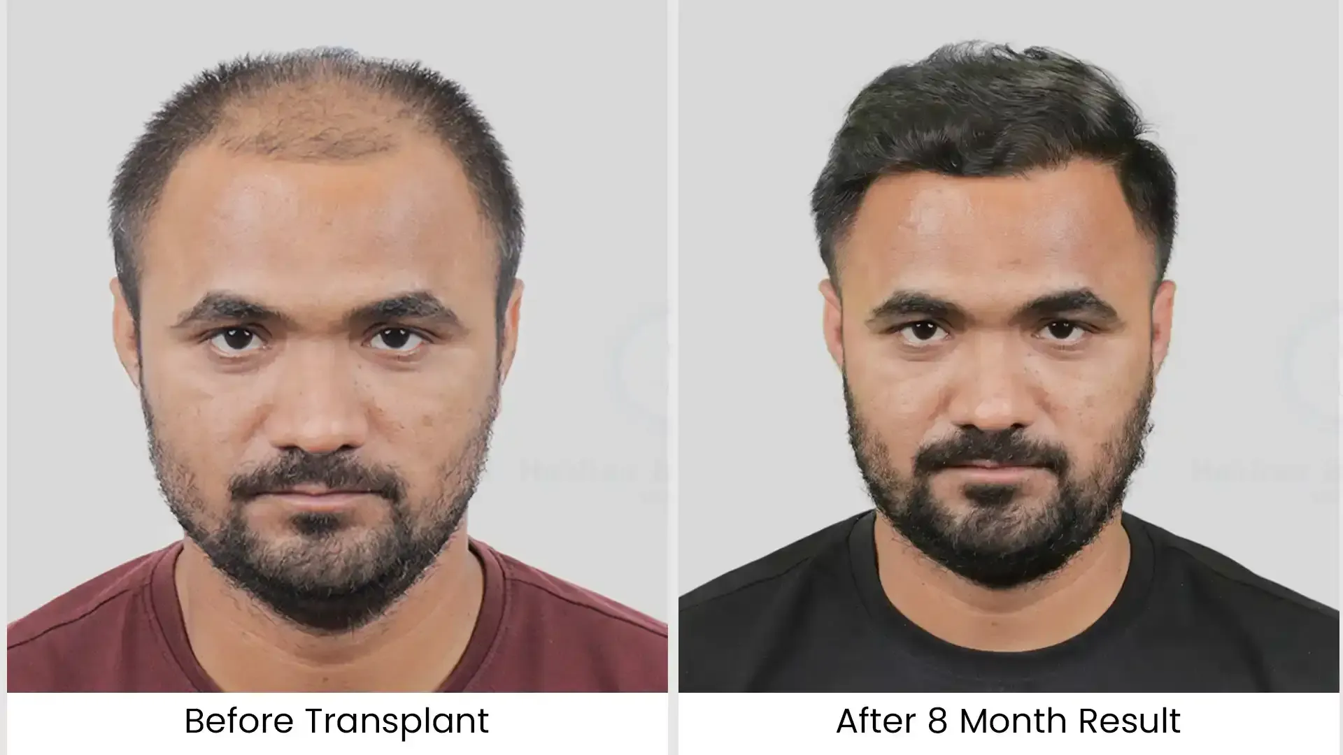 Hair Transplant Cost in Chandigarh 15 Before - after hair transplant - 4