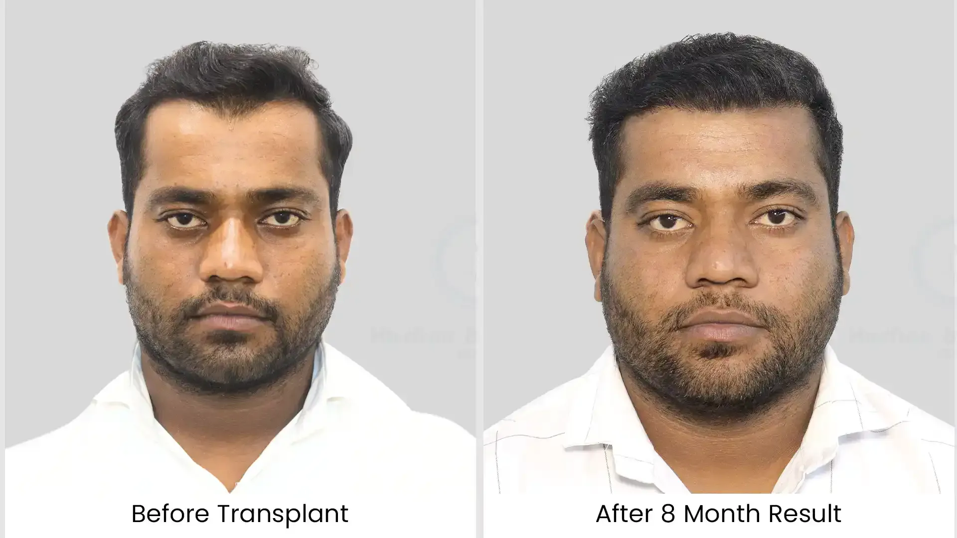 Before - after hair transplant - 4