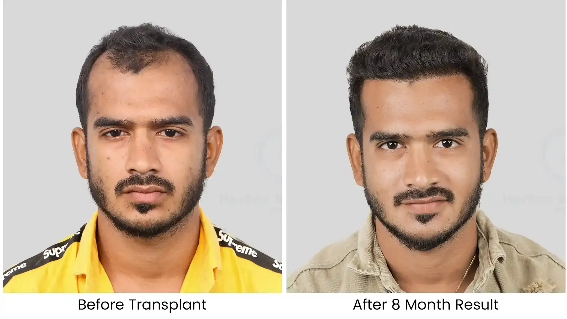Before - after hair transplant - 4