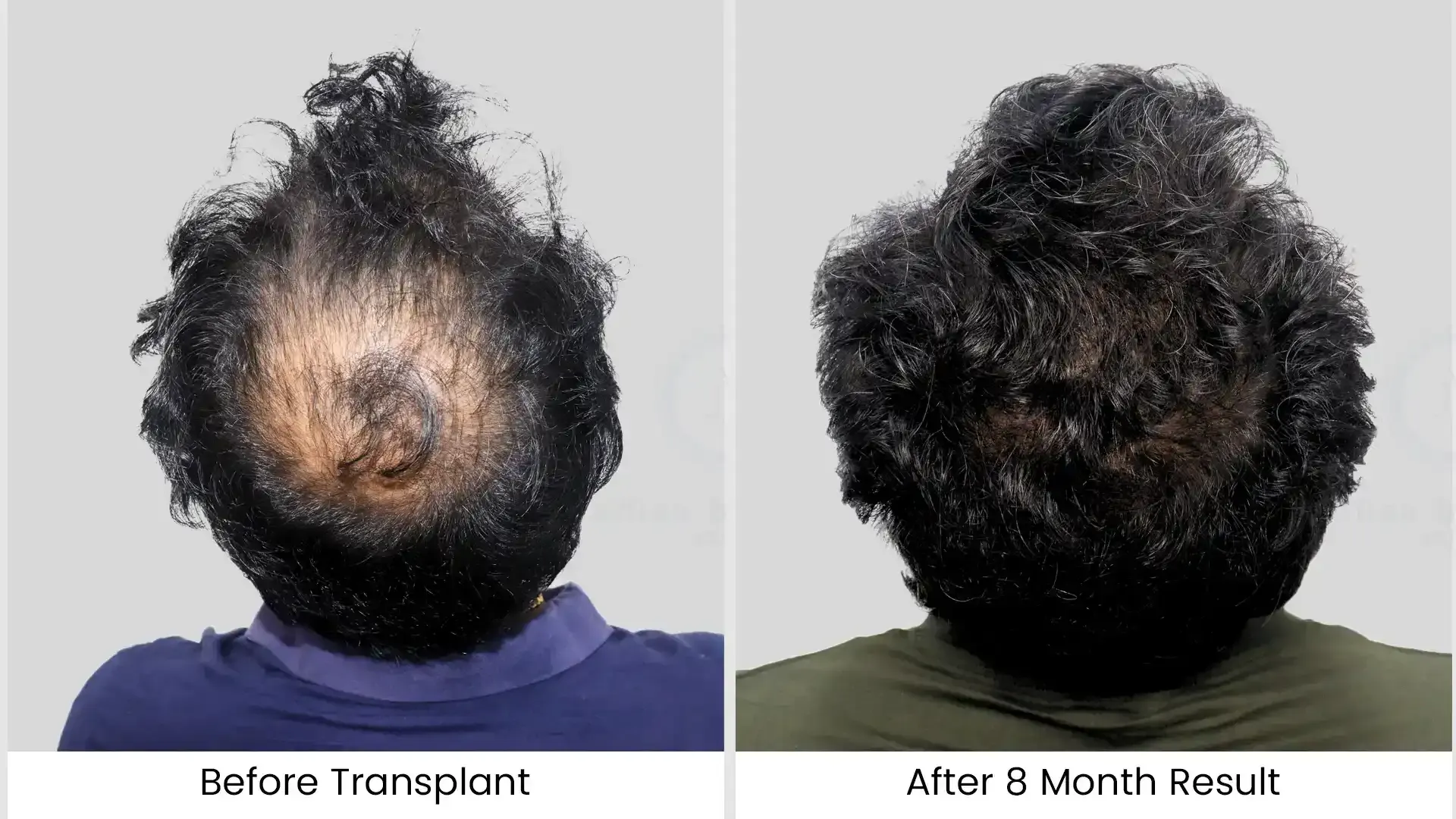 Before - after hair transplant - 4