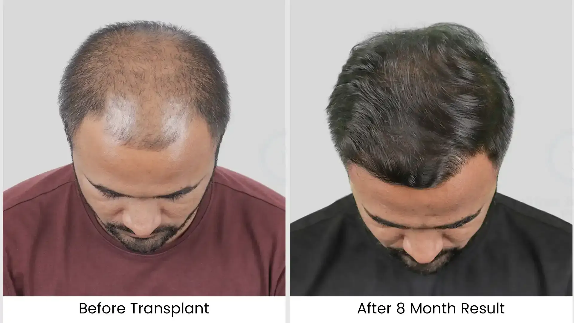 Before - after hair transplant - 4