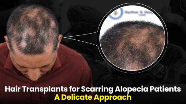 Delicate hair transplants approach for alopecia treatment