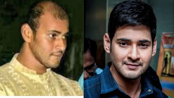mahesh babu hair transplant guilde