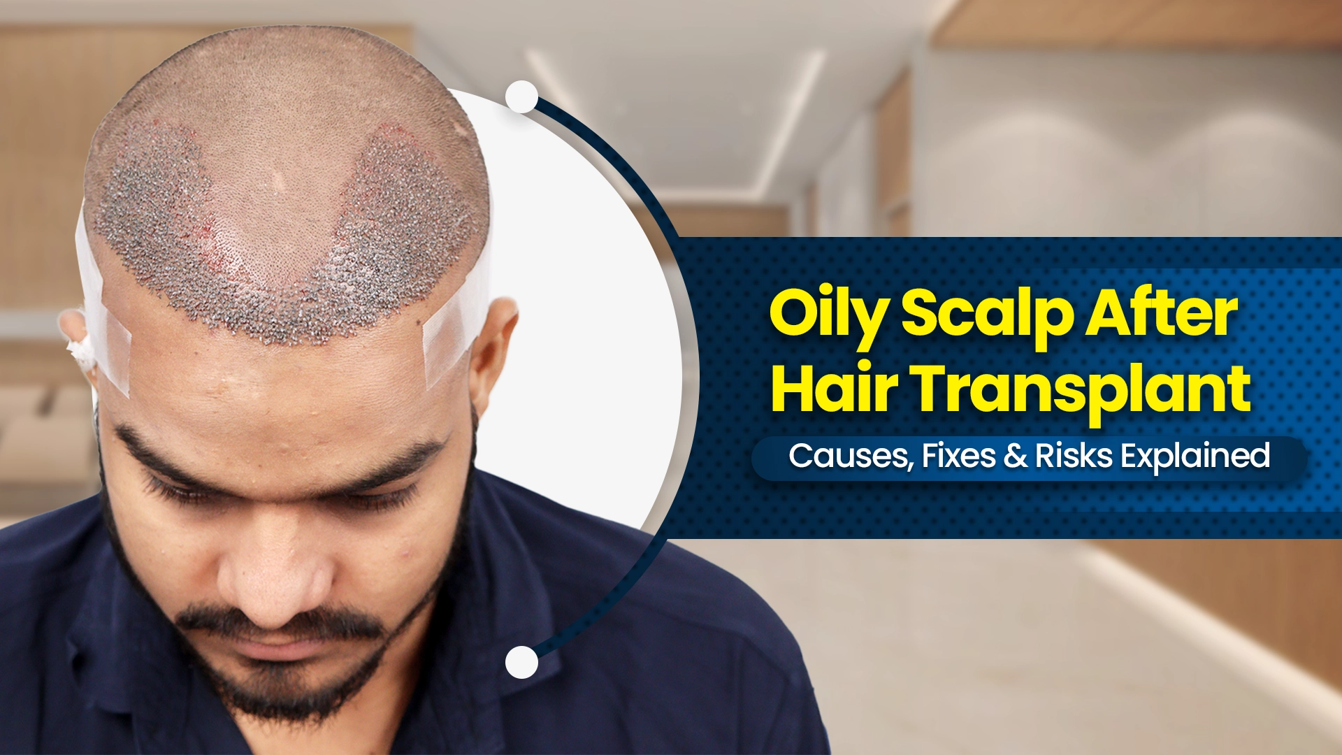 Oily Scalp After Hair Transplant causes and fixes explained