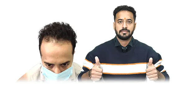 Hair transplant before and after results