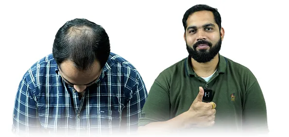 Hair transplant before and after results