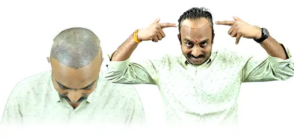 Hair transplant before and after results