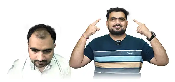 Hair Transplant Cost in Chandigarh 14 Hair transplant before and after results
