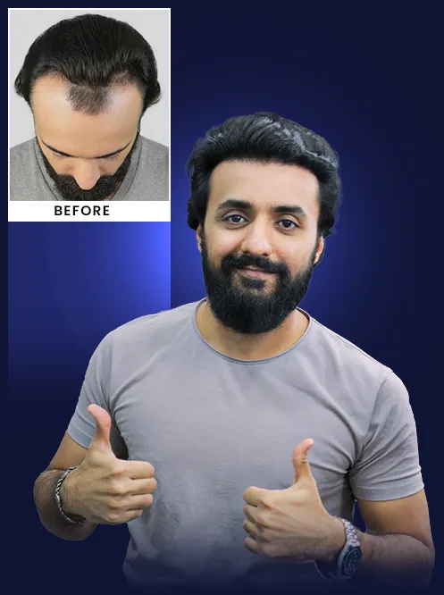 Why is India a Leading Destination for Hair Restoration