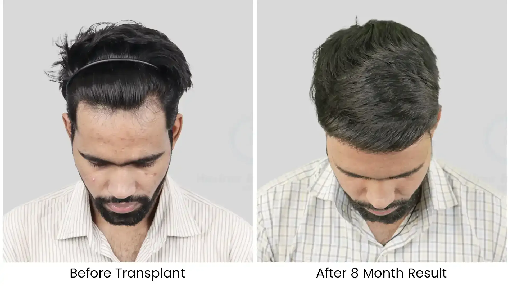 before after hair transplant - 2