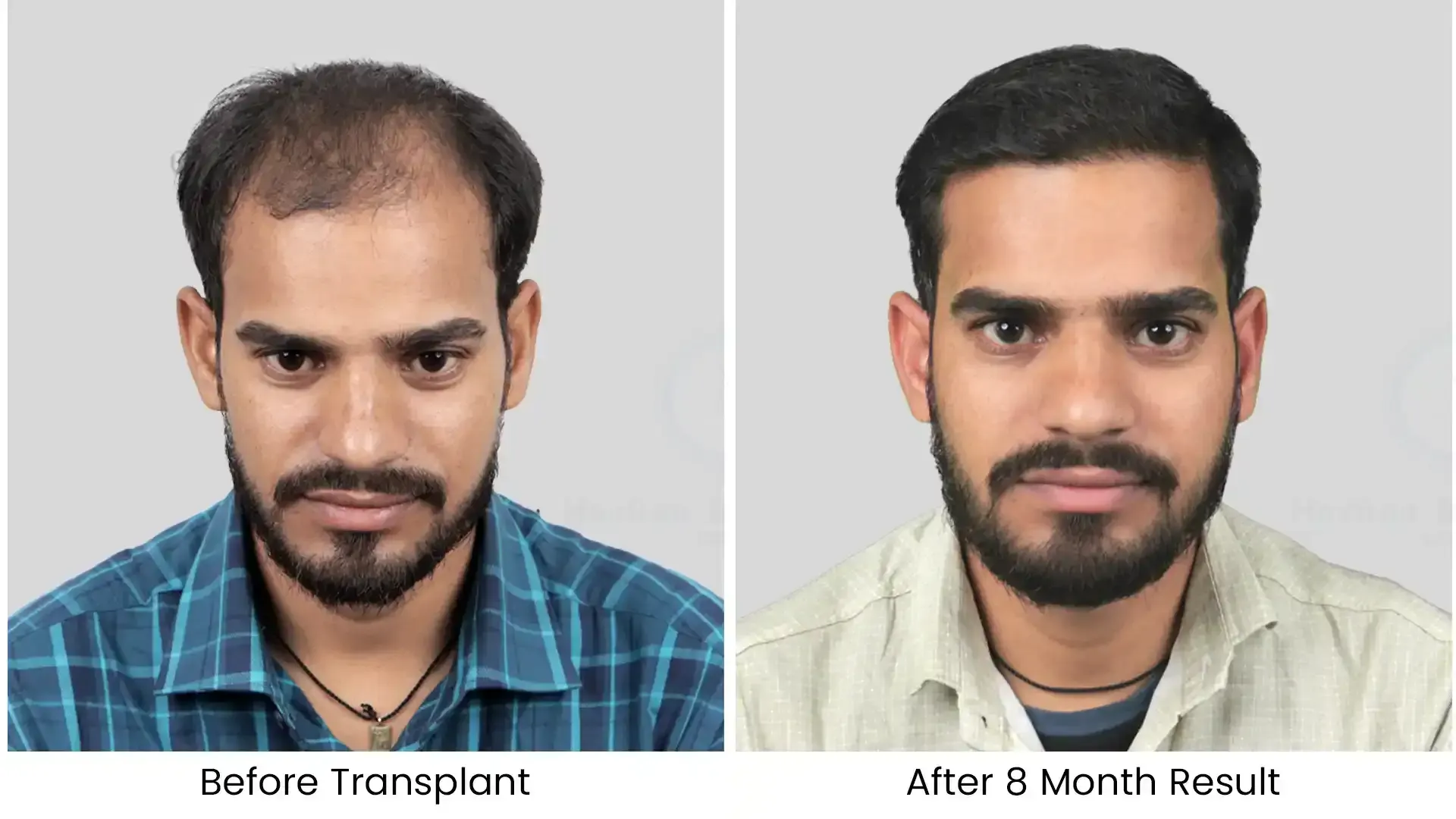 before after hair transplant - 3