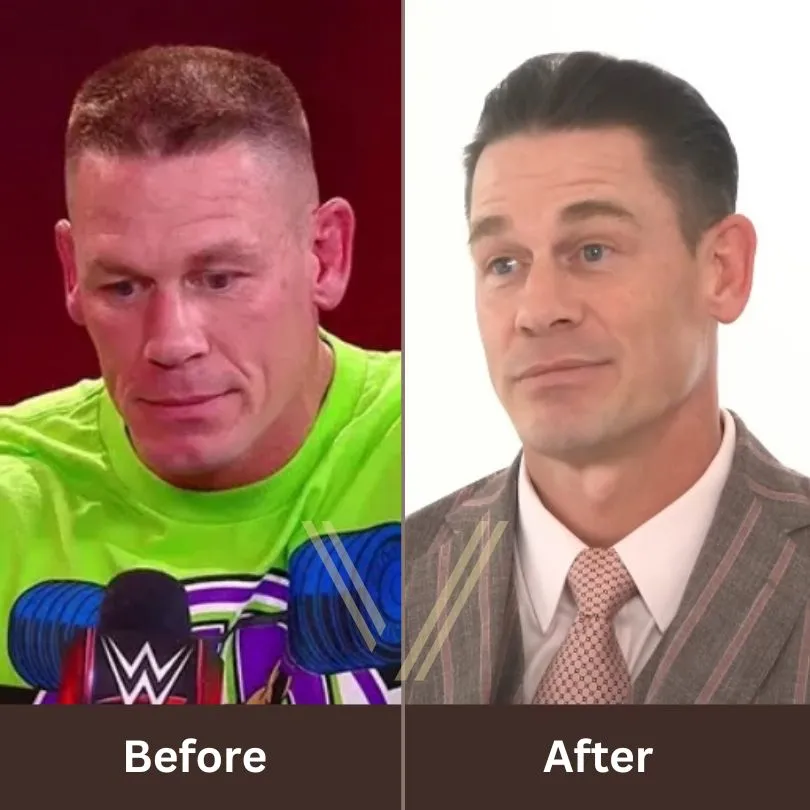 John Cena Hair Transplant: The Truth Behind His Transformation 2 John Cena before after Hair Transplant guilde