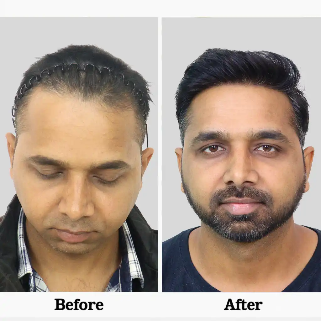 Big FUE hair transplant cost in delhi detail