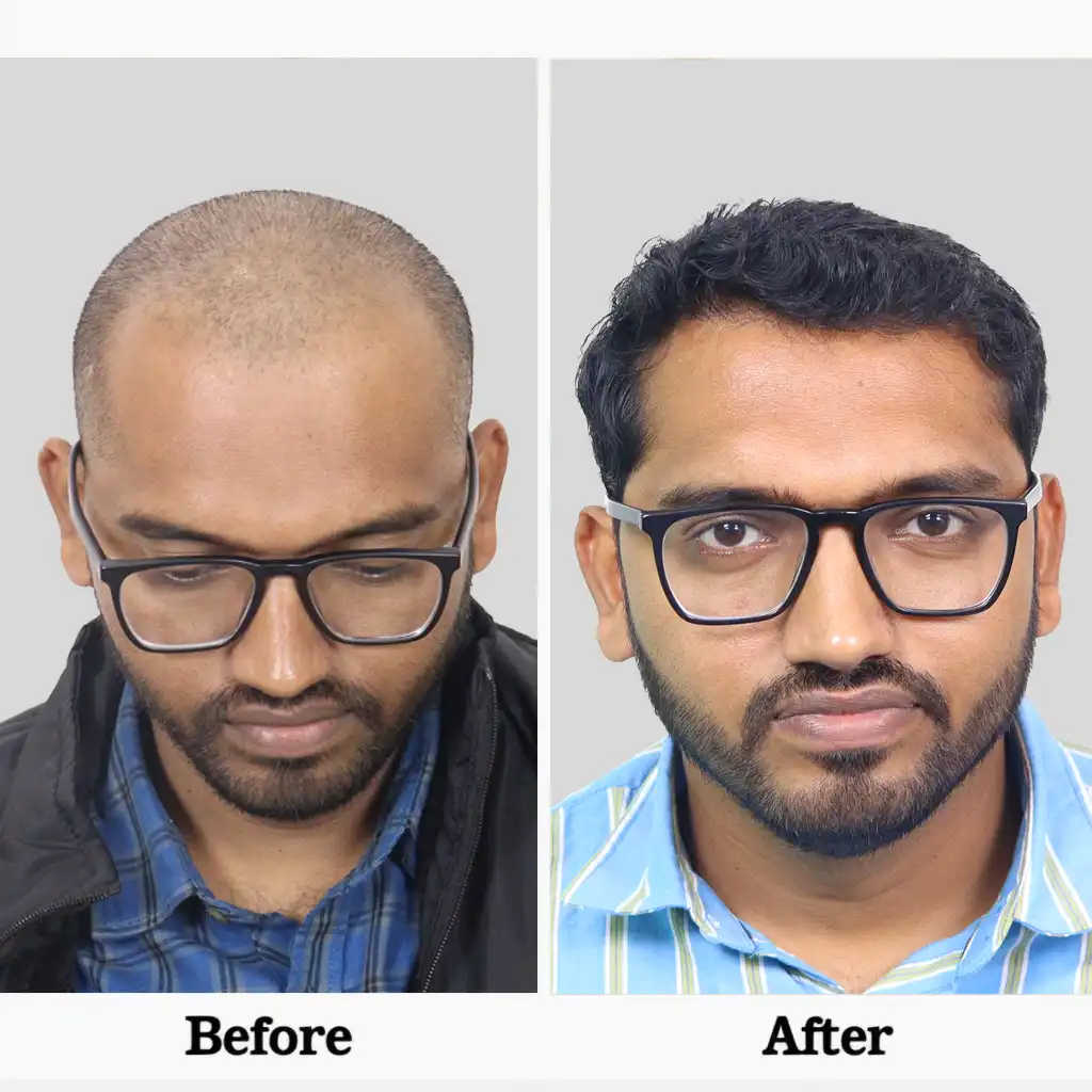 Bio FUE hair transplant cost in delhi detail