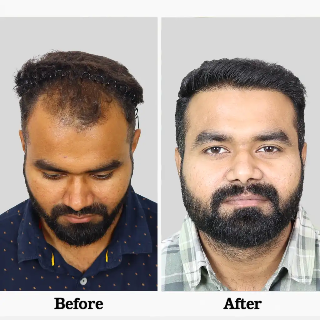Before After .2I FUE