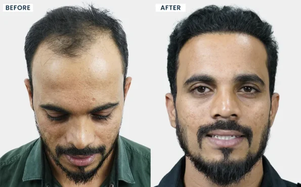 ROHIT ROKADE before and after