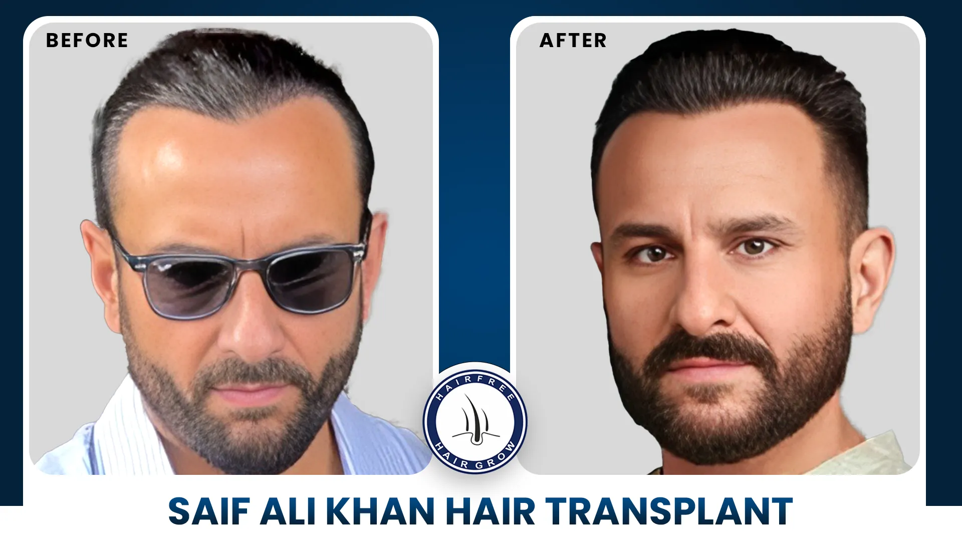Before and after hair transplant comparison.