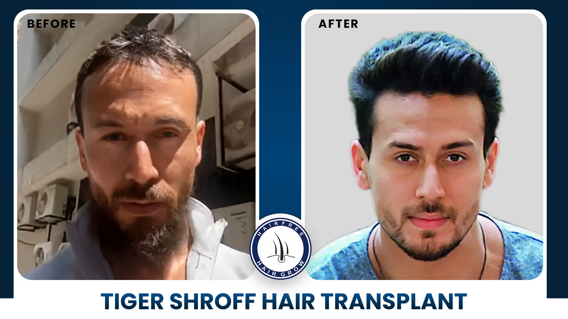 Before and after hair transplant results comparison showing improved hair density.