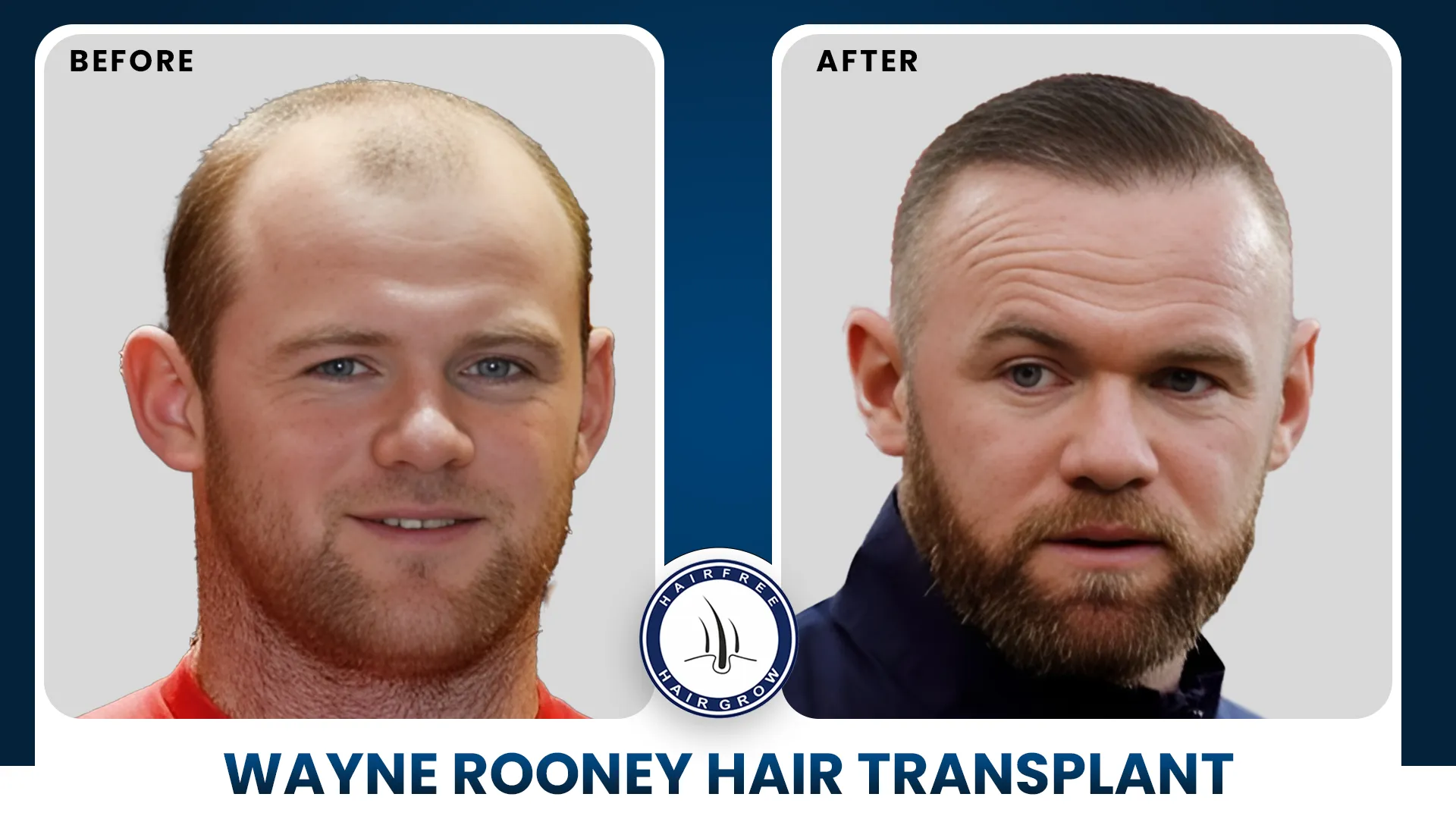 Celebrity Hair Transplants Famous Transformations And Results Celebrity Hair Transplants Famous Transformations And Results
