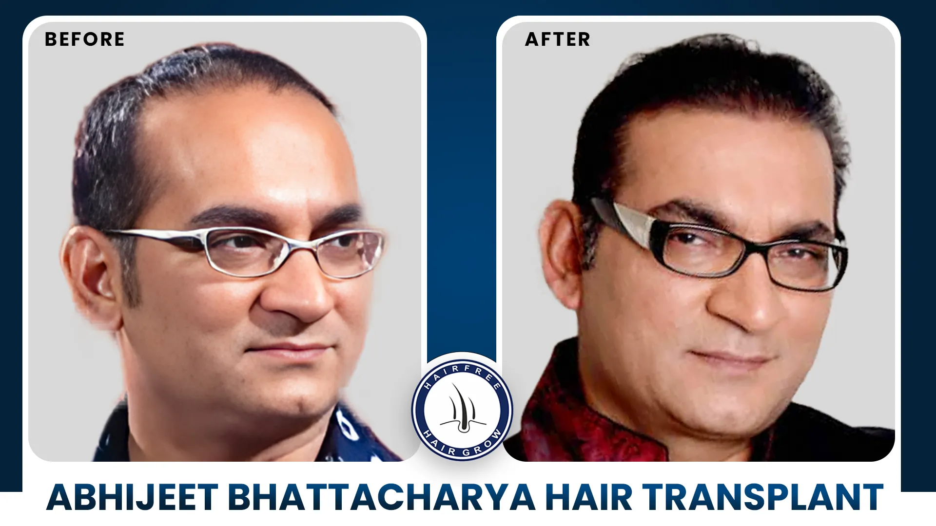 abhijeet bhattacharya Hair Transplant