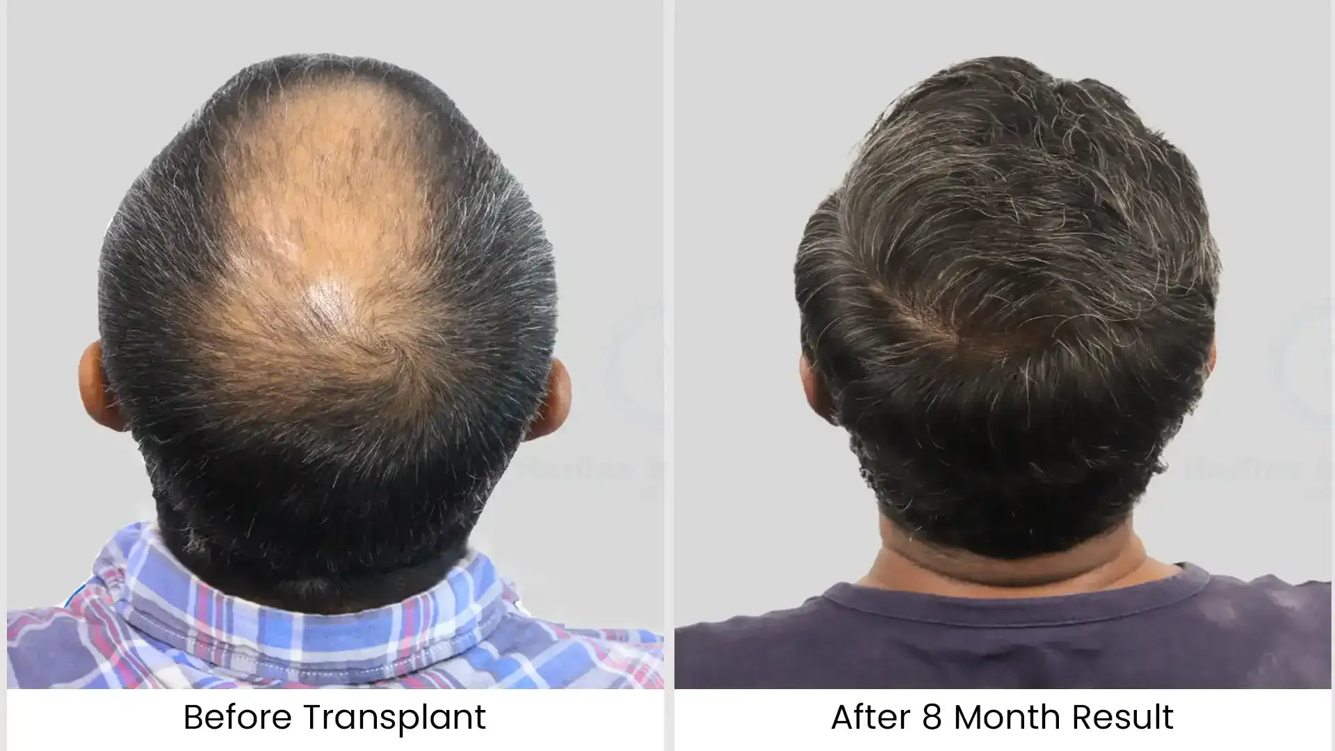 What is Hair Loss? Causes, Types and Treatments Explained by Experts 4 before after 1
