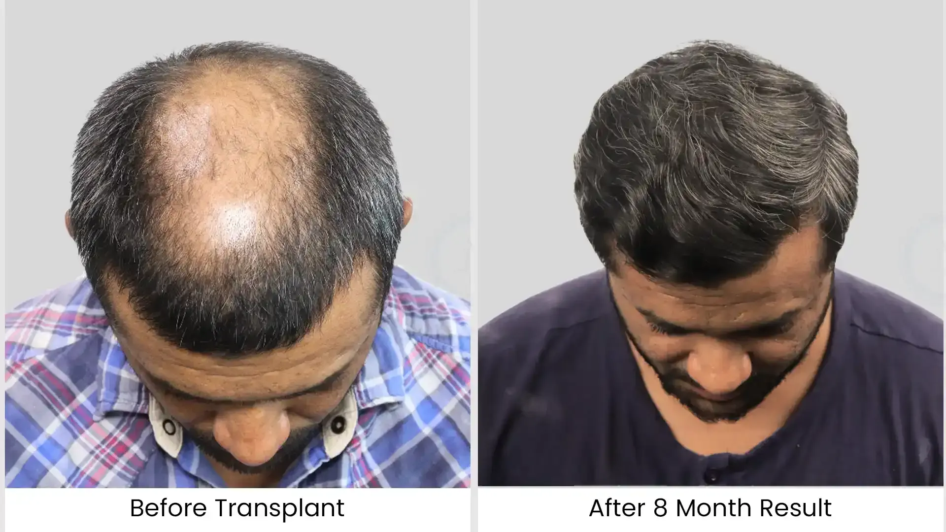 What is Hair Loss? Causes, Types and Treatments Explained by Experts 2 before after 3