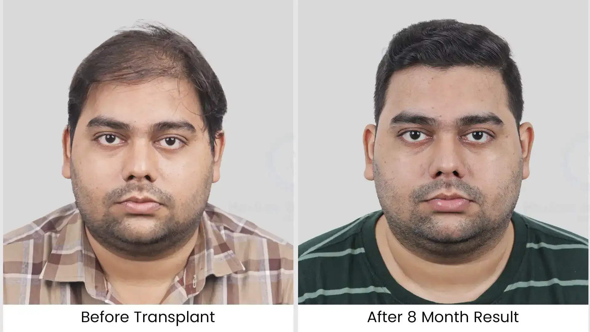 What is Hair Loss? Causes, Types and Treatments Explained by Experts 1 before after 4